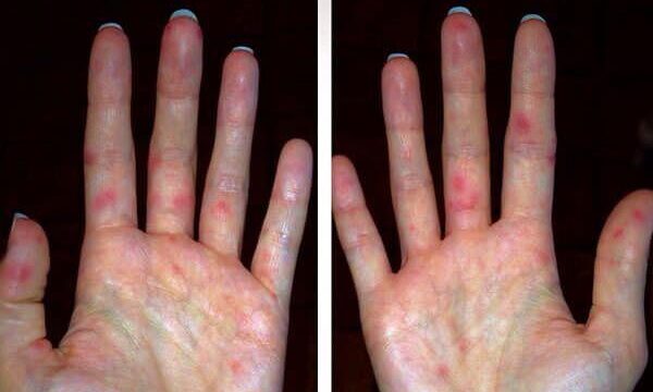 Ентеровірусна інфекція